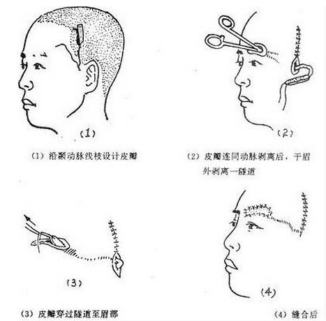 眉毛种植
